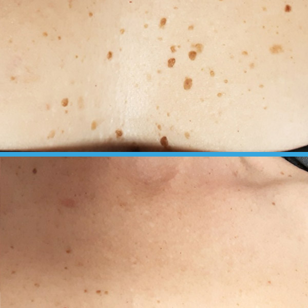 Before and after — Seborrhoeic keratoses